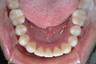 Severe Crowding and Crossbite Treated with Invisalign