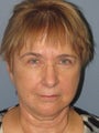 SMAS Facelift/LiteLift/Mini Lift