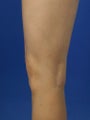 34 Year Old Female Treated for Spider Veins