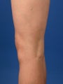 34 Year Old Female Treated for Spider Veins