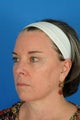 Female patient treated for lax skin and sun damage
