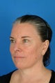 Female patient treated for lax skin and sun damage