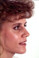 Revision rhinoplasty
