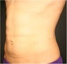 SmartLipo MPX