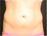 SmartLipo MPX