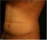 SmartLipo MPX