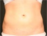 SmartLipo MPX