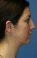 Chin/Neck Liposuction