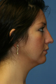 Chin/Neck Liposuction