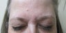 Patient treated for forehead lines