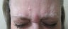 Patient treated for forehead lines