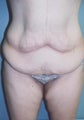 16 year old female patient