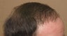 Hair transplant from chest to scalp