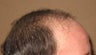Hair transplant from chest to scalp