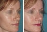 Female Revision Rhinoplasty