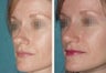 Female Revision Rhinoplasty