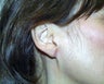 earlobe reduction