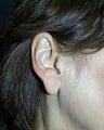 earlobe reduction