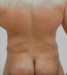 44 year-old male liposuction to the abdomen
