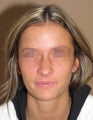 rhinoplasty - nose job photos