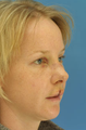 Nasal Fracture Repair