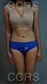 VASER lipo for body contouring