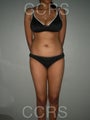 VASER lipo for body contouring