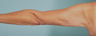 SmartLipo Liposuction of Arms