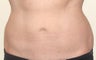 Coolsculpting