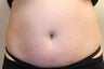 Coolsculpting