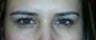 Botox Before and After
