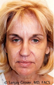 Facelift