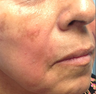 Female Patient Treated with Radiesse
