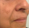 Female Patient Treated with Radiesse