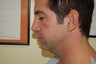 Pre and Post Radiesse Facial Shaping