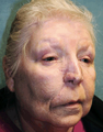 Skin Cancer Surgery