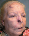 Skin Cancer Surgery