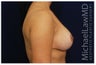 Breast Lift