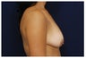 Breast Lift
