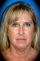 Laser Skin Resurfacing