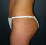 Butt Augmentation