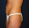 Butt Augmentation