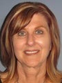 Blue Peel®, LiteLift™, Platysmaplasty on 57-year-old Woman