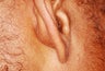 Female Patient Treated for Keloid