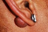 Female Patient Treated for Keloid