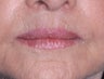 75 Year Old Female Treated For Thin Aging Lips