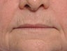 75 Year Old Female Treated For Thin Aging Lips