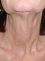 Botox