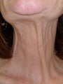 Botox