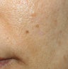 Mole Removal